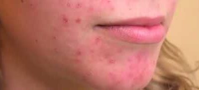 TRĄDZIK RÓŻOWATY (Rouzerfia lub Rosacea – ang.)